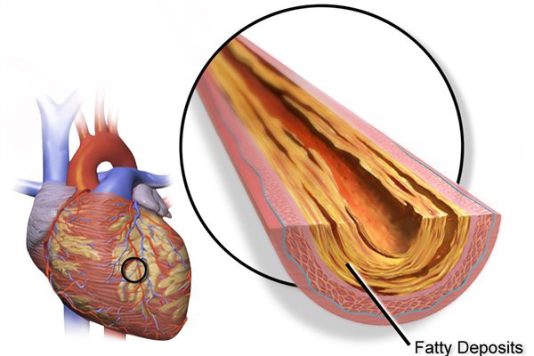 lumbrokinase powder for coronary heart disease