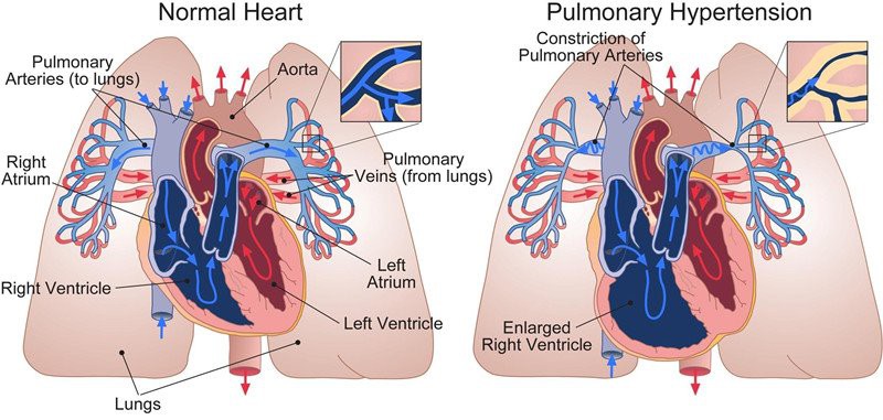 lumbrokinase powder for pulmonary heart disease
