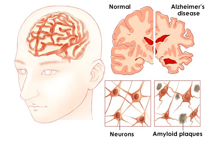 Alzheimers